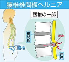 腰椎椎間板ヘルニアの図